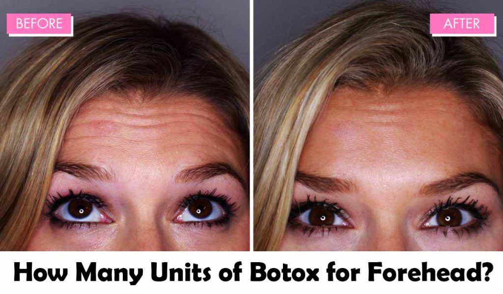 How Many Units of Botox for Forehead Lines