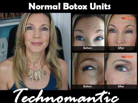 How Many Units of Botox is Normal