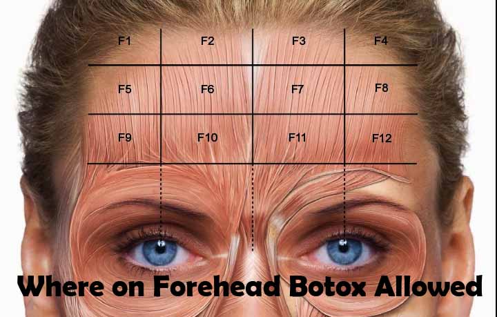 Where on the Forehead is Botox Allowed
